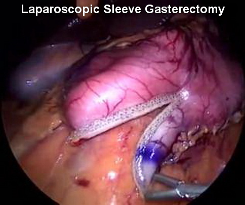 Advanced Laparoscopic Surgery Tasks